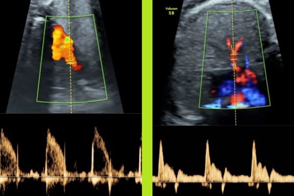 Un estudio abre la puerta a la mejora del desarrollo pulmonar de fetos demasiado pequeños