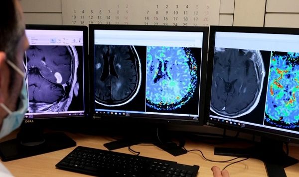 Importancia de la resonancia magnética en la detección y caracterización de los tumores cerebrales