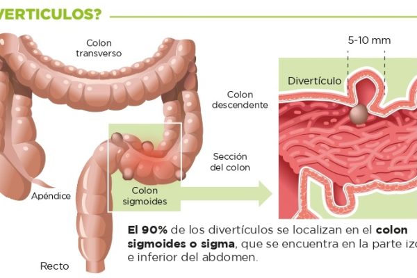 Hasta el 40% de la población mayor de 50 años tiene divertículos en el colon, un 20% de ellos con síntomas