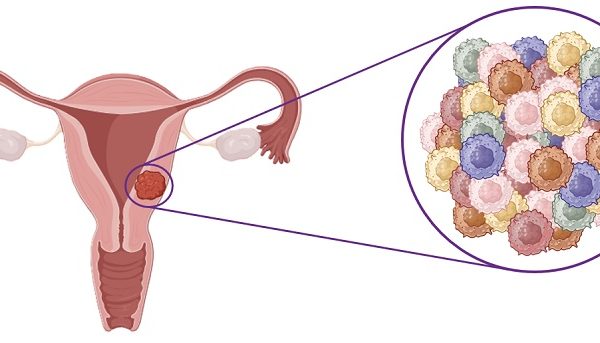 Investigación pionera para identificar marcadores genéticos que permitan un diagnóstico temprano y diferencial de tumores uterinos