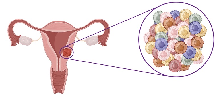 Investigación pionera para identificar marcadores genéticos que permitan un diagnóstico temprano y diferencial de tumores uterinos