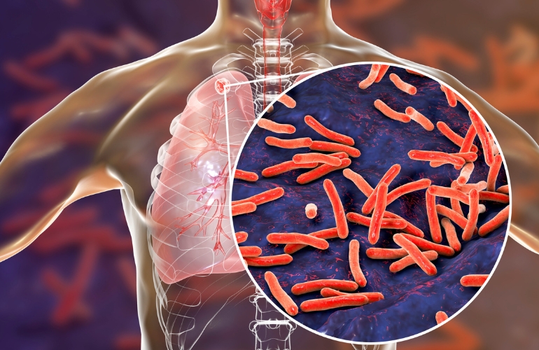 Nuevos hallazgos sobre la tuberculosis podrían cambiar el tratamiento de los trastornos inflamatorios