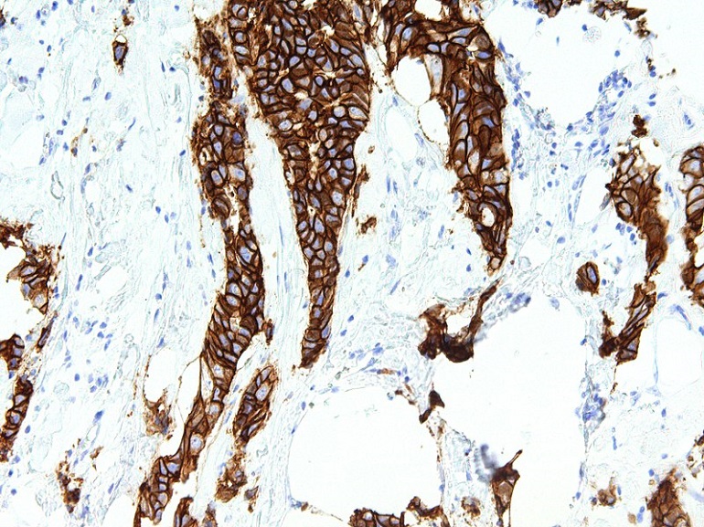 Identificada una firma genética vinculada al pronóstico del cáncer de mama