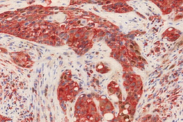 El abordaje multidisciplinar en cáncer de cabeza y cuello salva vidas