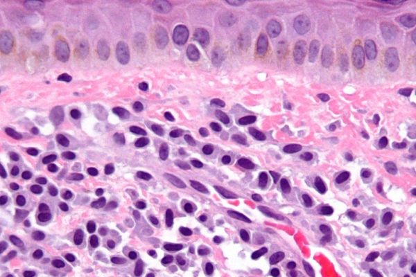 El sistema inmune está involucrado en el desarrollo de la mastocitosis