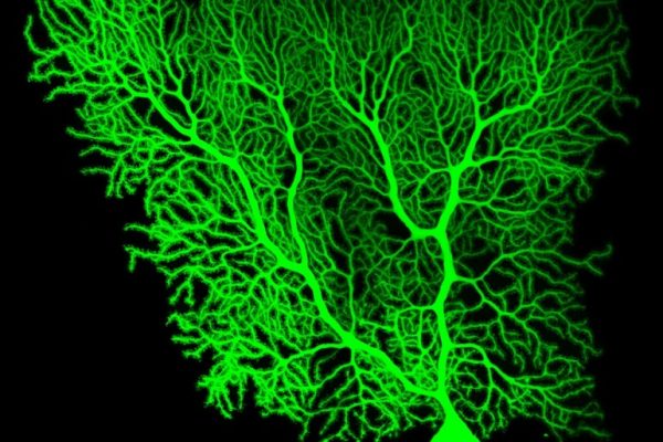 Nueva vía para reducir los efectos secundarios de las cirugías en el cerebro