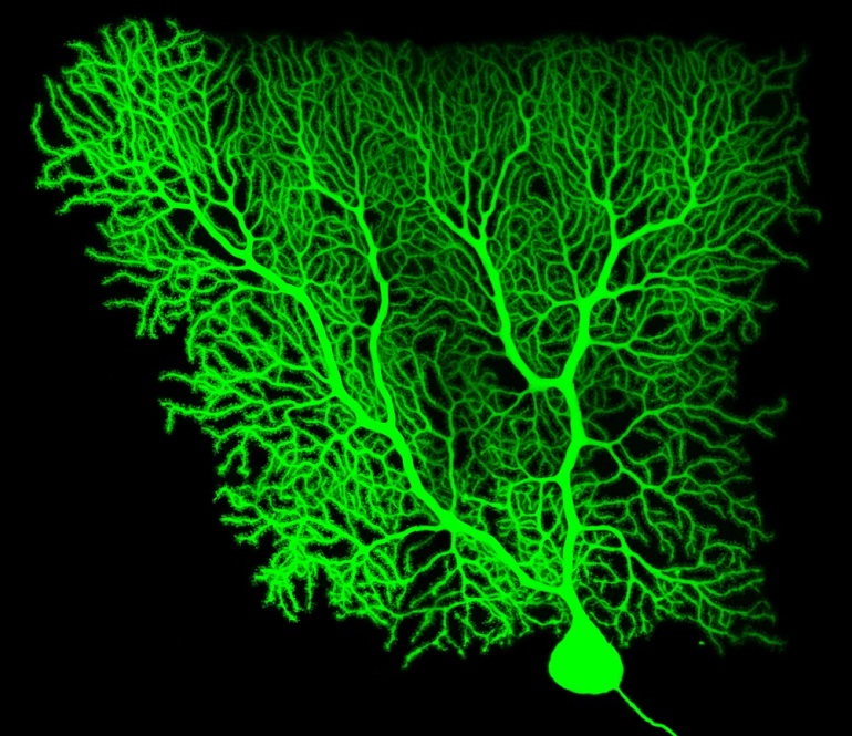 Nueva vía para reducir los efectos secundarios de las cirugías en el cerebro