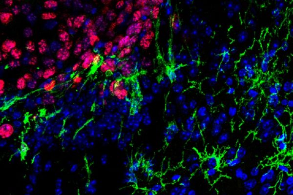 Descubren una nueva estrategia para combatir las metástasis cerebrales de melanoma  