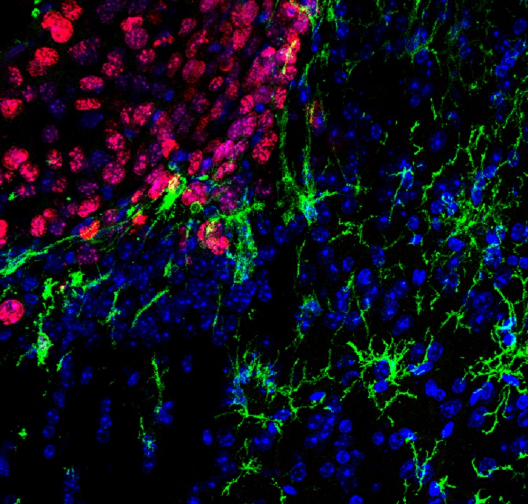 Descubren una nueva estrategia para combatir las metástasis cerebrales de melanoma  