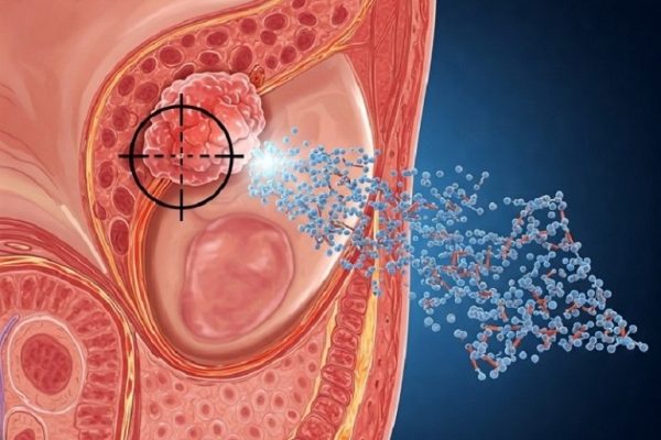 Desarrollan nanopartículas orgánicas capaces de llegar a los tumores de próstata y liberar una cantidad efectiva de fármaco