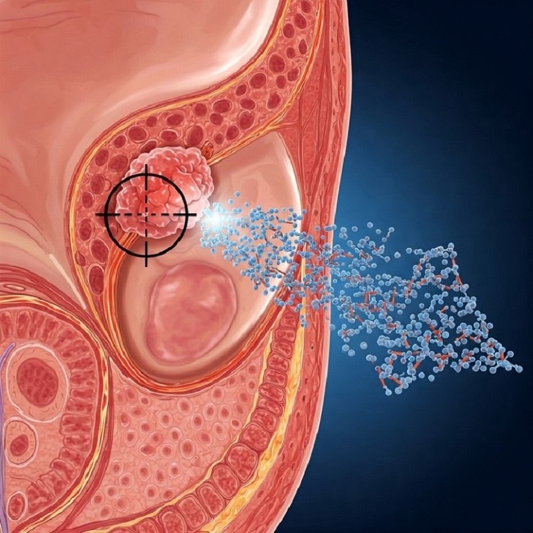 Desarrollan nanopartículas orgánicas capaces de llegar a los tumores de próstata y liberar una cantidad efectiva de fármaco