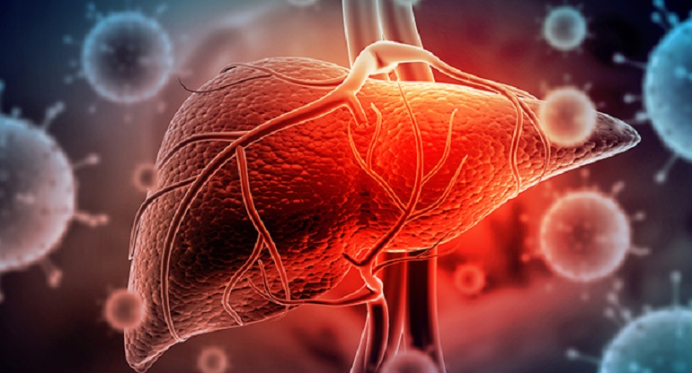 Aumento de la incidencia y mortalidad del cáncer de vías biliares