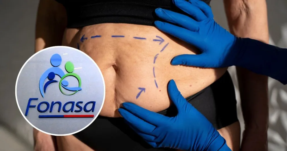 Bono PAD de Fonasa: requisitos y prestaciones para cirugías bariátricas y abdomen flácido